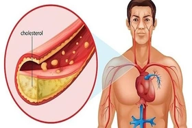 6 loại dầu ăn tốt cho người bị cholesterol cao