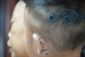 Gia tăng tình trạng chốc lở da ở trẻ em