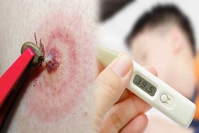 Các câu hỏi thường gặp liên quan đến sốt ve mò