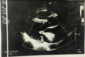 Bệnh viện Đa khoa tỉnh phẫu thuật nội soi thay van tim cho nhiều bệnh nhân ngoại tỉnh