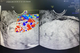 Phẫu thuật lấy thai thành công cho sản phụ bị rau tiền đạo trung tâm, rau cài răng lược cực nguy hiểm