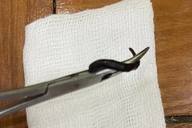 Phát hiện con vắt sống ký sinh trong mũi bé gái 32 tháng tuổi