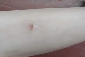 Nâng cao cảnh giác và phòng ngừa bệnh giun rồng