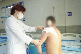 Người đàn ông bị bỏng nặng do xăng bén lửa