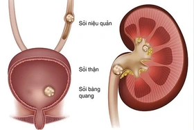Cách ăn uống tốt nhất giúp ngăn ngừa hình thành sỏi thận