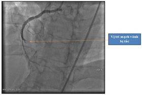 Gần 2 giờ liên tục ép tim, sốc điện cứu sống người bệnh nhồi máu cơ tim ngừng tuần hoàn