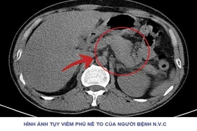 Cảnh báo nguy cơ viêm tụy cấp do lạm dụng rượu bia – Câu chuyện từ một ca cấp cứu tại Bệnh viện Đa khoa tỉnh Phú Thọ
