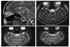 Điều trị kịp thời căn bệnh rối loạn phổ viêm tủy thị thần kinh thể hiếm gặp