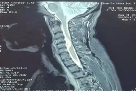 Bệnh viện Đa khoa Hòa Bình phẫu thuật thành công ca mổ hiếm u tủy sống vùng cổ