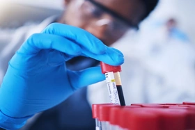 Chỉ cần xét nghiệm máu có thể dự báo sớm bệnh tim di truyền phổ biến nhất thế giới