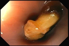 Hóc hạt hồng xiêm - xử trí nhanh trong “thời gian vàng”