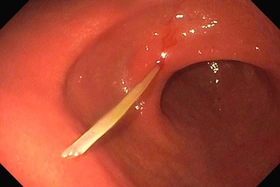 Hóc xương cá, nam thanh niên suýt thủng dạ dày