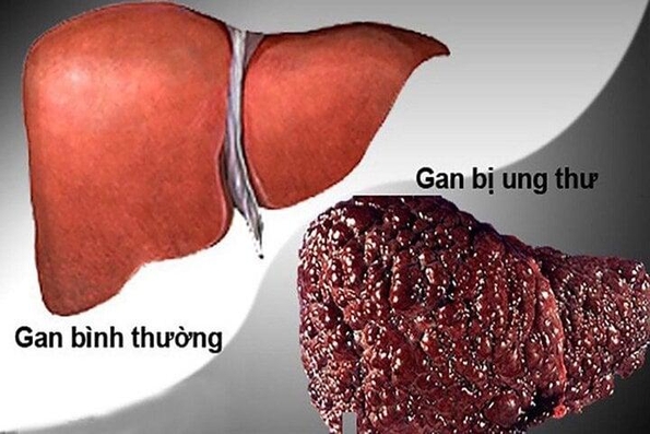 5 dấu hiệu cảnh báo ung thư gan sớm