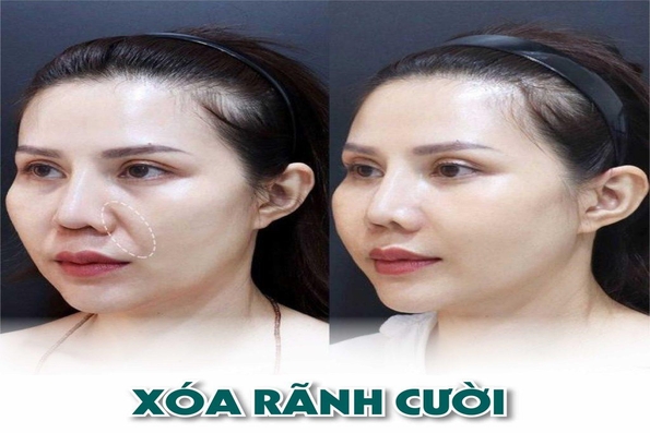 Xóa nhăn rãnh cười bằng phương pháp nào? Ở đâu ? an toàn hiệu quả