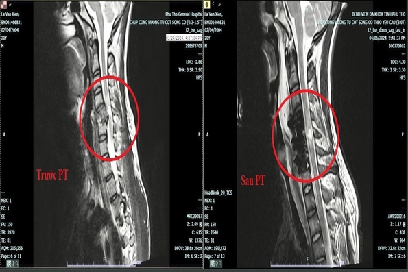 Phẫu thuật và điều trị thành công ca chấn thương cột sống cổ sau tai nạn giao thông