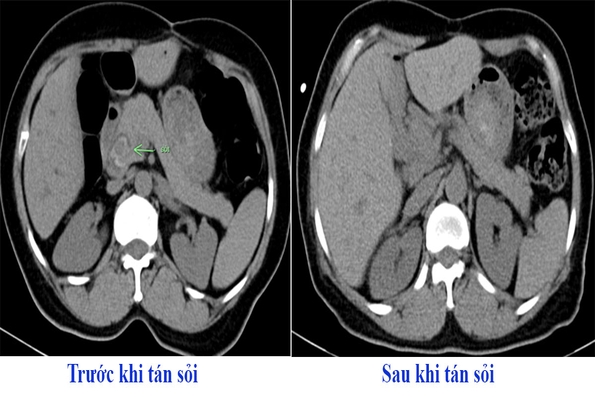 Tán sỏi đường mật qua da - Phương pháp điều trị sỏi mật an toàn, hiệu quả