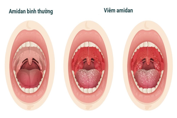 9 câu hỏi thường gặp liên quan đến bệnh viêm amidan