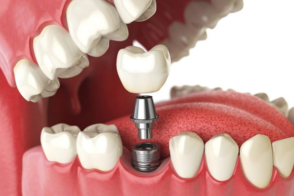 Khi nào cần trồng răng implant? Trồng răng implant có đau không?