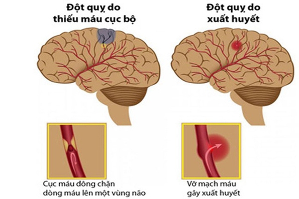 Có nên dùng An cung ngưu hoàng hoàn để phòng và điều trị đột quỵ?