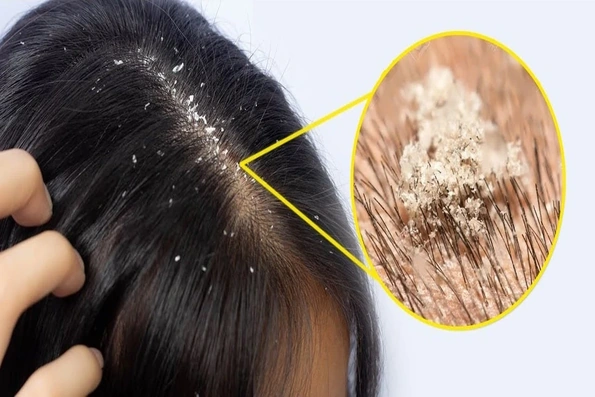 Dầu gội trị gàu ngứa da đầu: Chọn đúng, dùng đúng mới hiệu quả