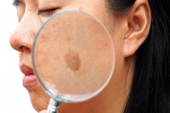 11 cách tự nhiên làm mờ đốm đồi mồi