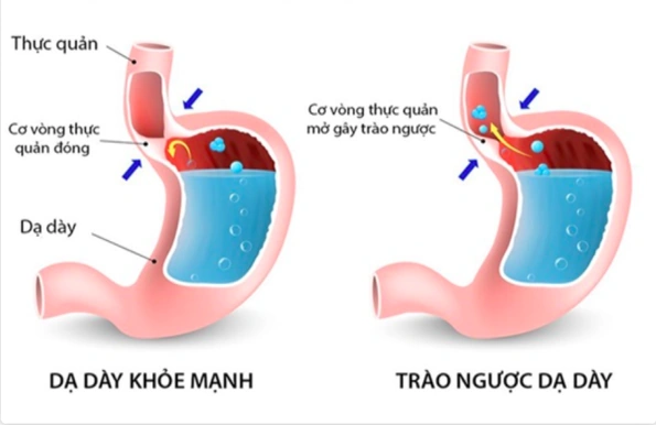 Ai dễ bị trào ngược dạ dày - thực quản?