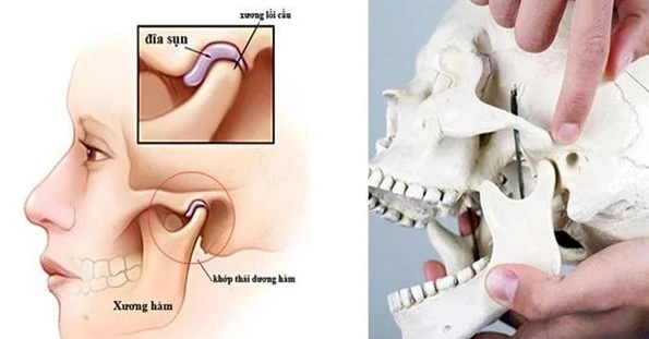 Dinh dưỡng hỗ trợ phòng ngừa biến chứng của viêm khớp thái dương hàm