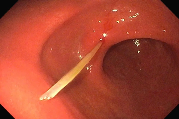 Hóc xương cá, nam thanh niên suýt thủng dạ dày